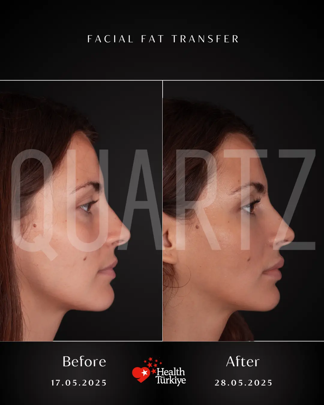 Before & After: Facial Fat Transfer New Result 3
